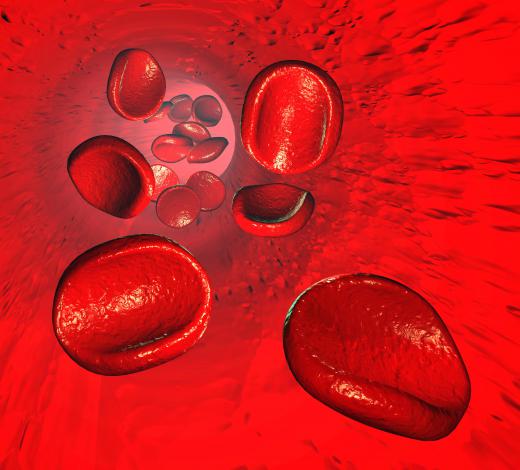 In sickle cell anemia, the red blood cells are sickle shaped instead of the normal rounded donut shape.