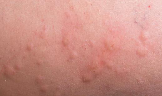 The appearance of wheals often has to do with an outbreak of hives.