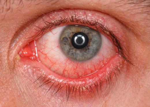 Expired eye drop may be ineffective, but could also cause irritation or infection of the eye.