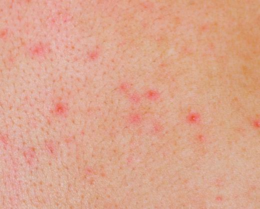 An itchy skin rash.