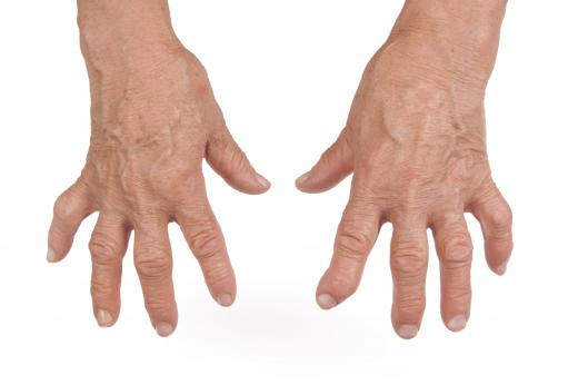 Rheumatoid arthritis is an autoimmune disease.