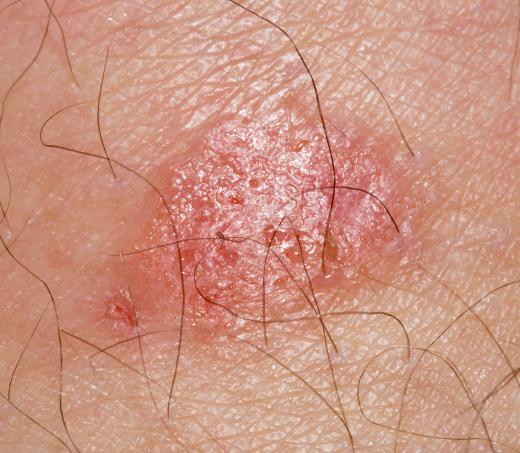 It's best to get an official diagnosis of ringworm from a doctor so it's not confused with another type of rash.