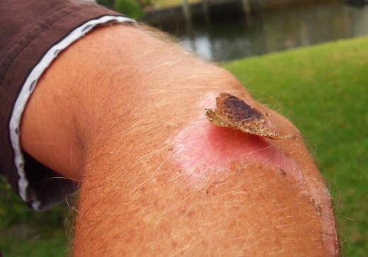 When a skin abrasion heals, a scab will fall off on its own, so there's no need to pick at it.