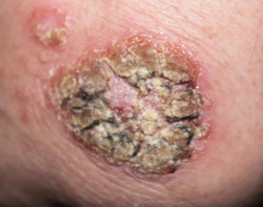 A white scab has many causes, some serious.