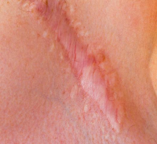 A hypertrophic scar.