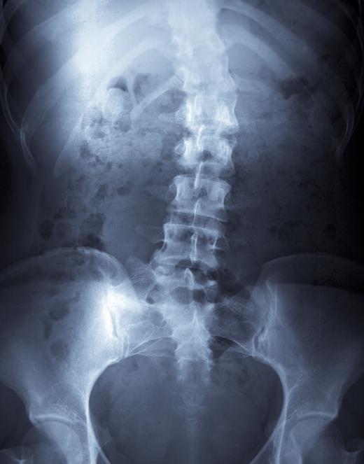 Centronuclear myopathy may lead to scoliosis, an abnormal curvature of the spine.