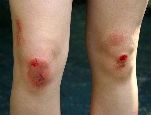 Organisms that cause soft tissue infection usually enter the body through minor scrapes or cuts.