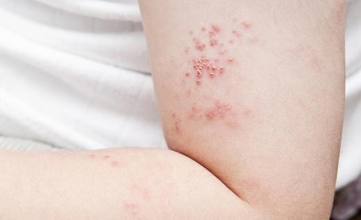 The shingles virus causes a painful rash on the skin.