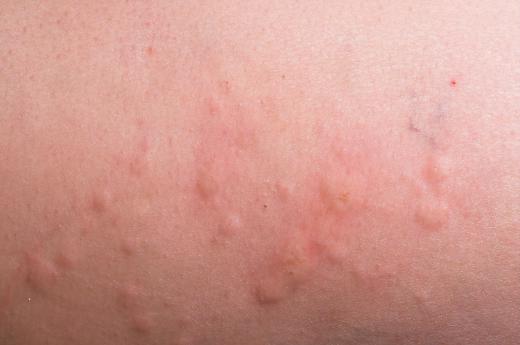 Chlorine rash appears as small, clustered bumps.