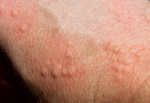 An aspartame allergy may cause skin hives.