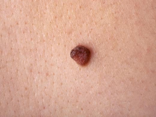 A fairly symmetrical skin mole.