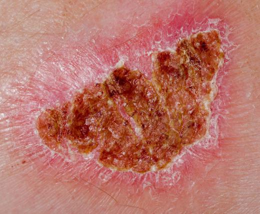 Using peroxide on wounds can halt the natural healing process.