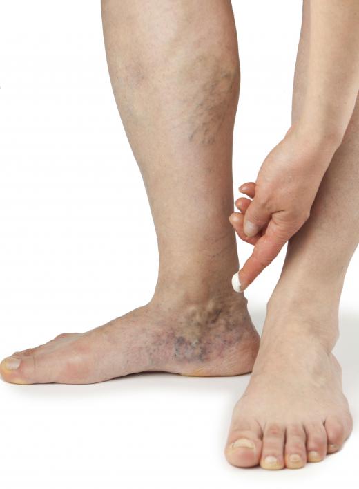 Spider veins on the lower legs and ankles may be a side effect of clobetasol use.