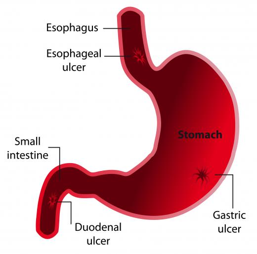 A duodenal ulcer appears on the lining of the duodenum, which is the upper section of the small intestine.