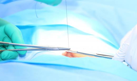 Sutures should be left in until a medical professional removes them.