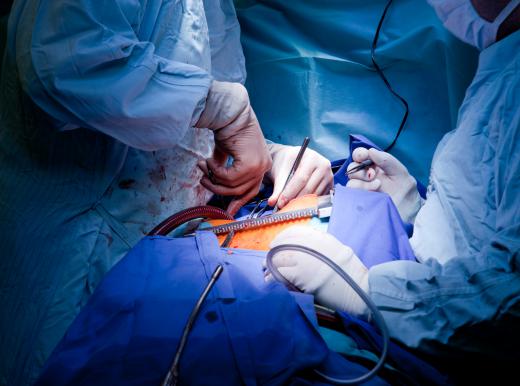 Heart surgery may be required to treat forms of heart disease.