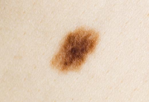 Flat skin melanoma.