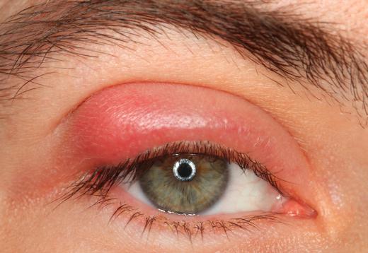 Hormonal changes may cause swollen eyes.