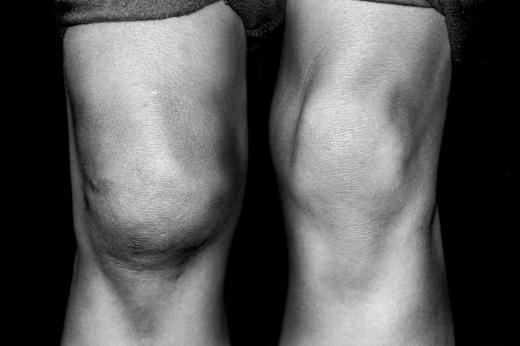 A person with knee effusion.