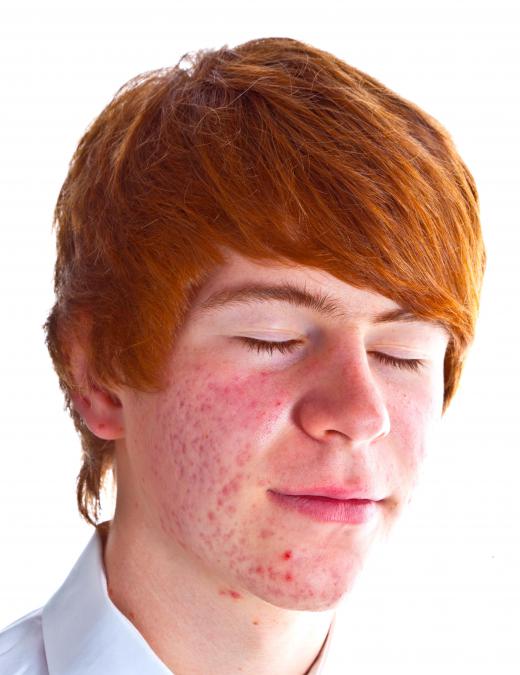 Excessive sebum often causes acne.