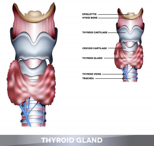 A person with hypothyroidism has a thyroid that under-produces necessary hormones.