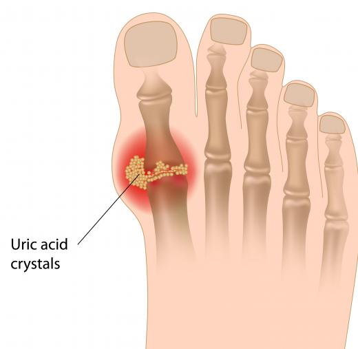 Uric acid is involved in the development of gout.