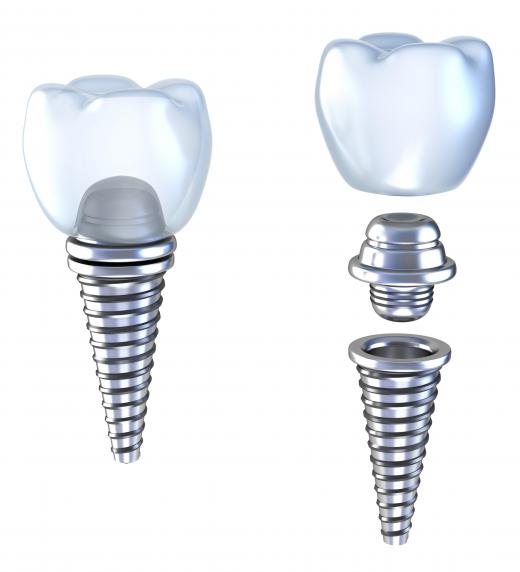 An illustration of the parts of a dental implant. Those installed in the upper jaw are called maxillary implants.