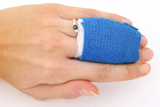 A woman wearing a splint for a torn ligament in her finger.