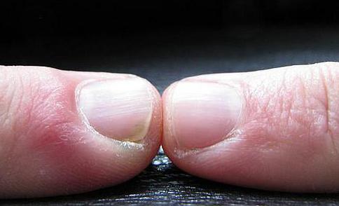 The parallel lines that run from the base to the tip of a fingernail become more prominent with age.