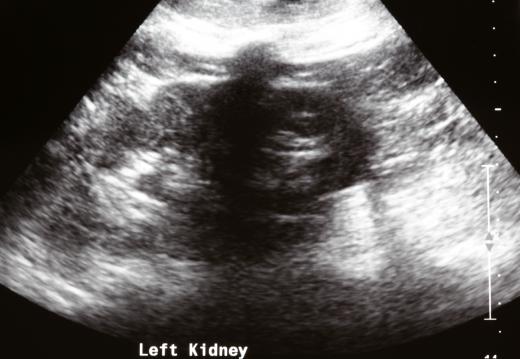 Nephrostomy tubes are inserted in the kidneys using an ultrasound for guidance.