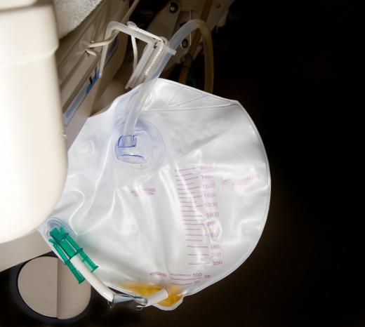 Urine flows through a catheter to a special collection bag.