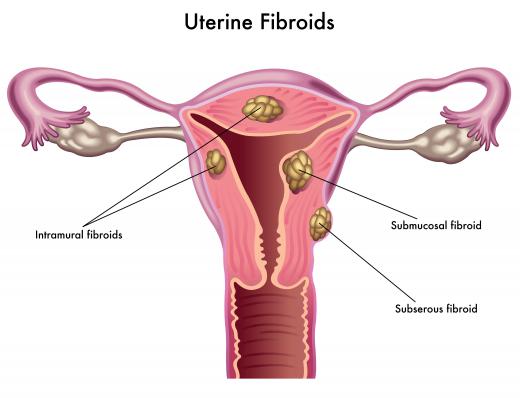 Uterine fibroids are the most common cause of a swollen uterus.