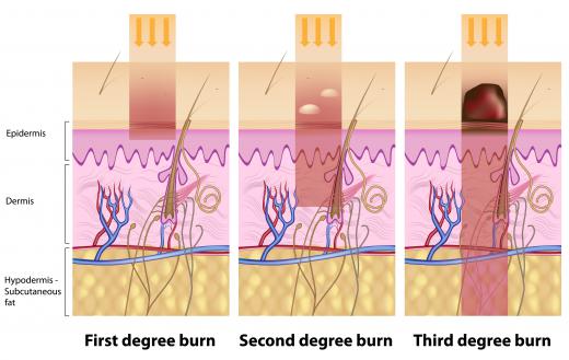 An illustration of the degrees of  damage UV rays can cause to the skin.