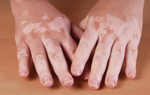 Patients with stiff person syndrome might also suffer from vitiligo.