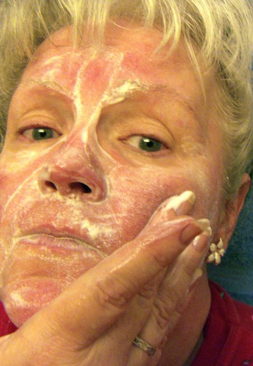 Metronidazole is commonly used to treat rosacea.