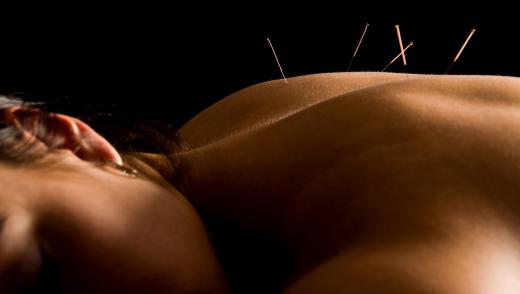 Acupuncture may be offered at wellness centers and clinics.