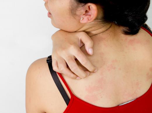 Some viral infections can cause a skin rash.