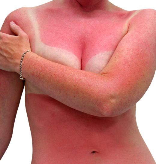 Ultimately, preventative measures and avoiding burning in the first place are the best ways to treat a sunburn.