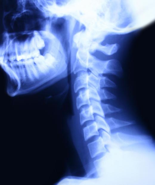 Most cases of cervical lordosis are mild and require no treatment.