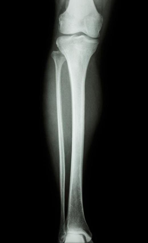 A femoral nailing is surgery to repair a broken femur using the help of an X-ray.