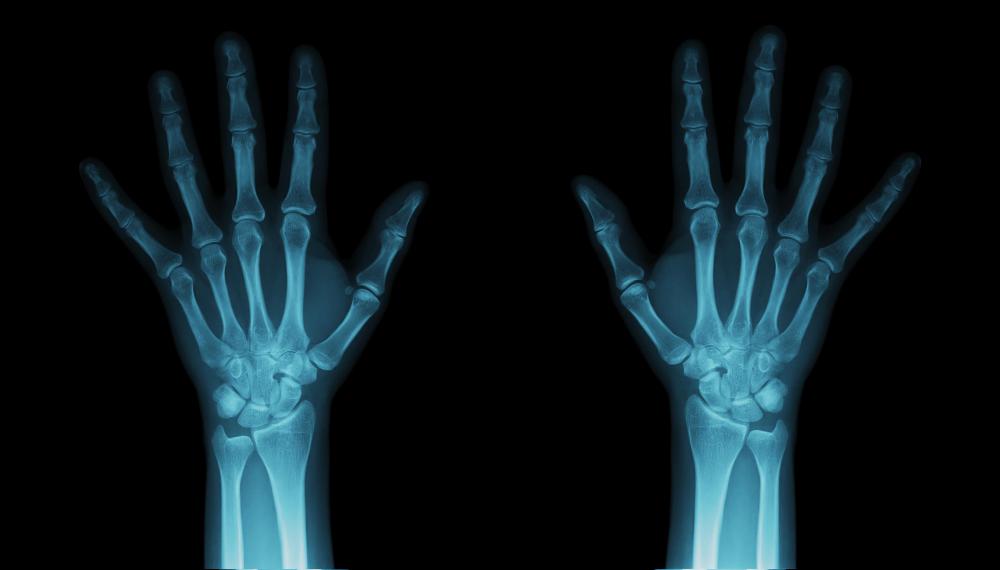 What Are the Signs of a Hairline Wrist Fracture?